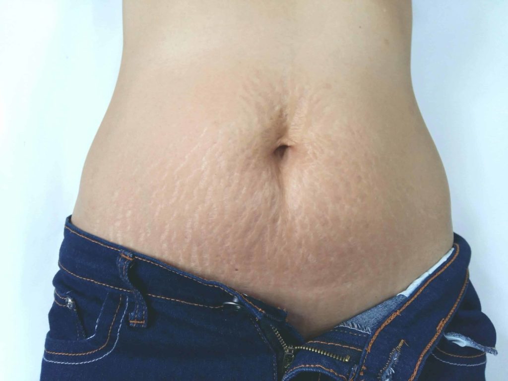 Treatments to reduce & soften SCARS Treatments to reduce & soften SCARS