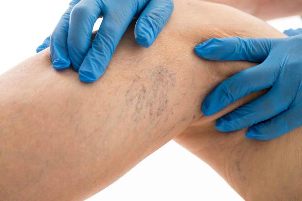 Spider vein treatment