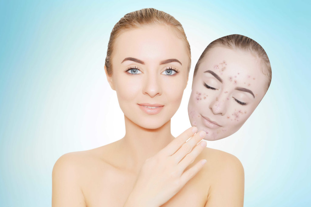 Acne laser treatment