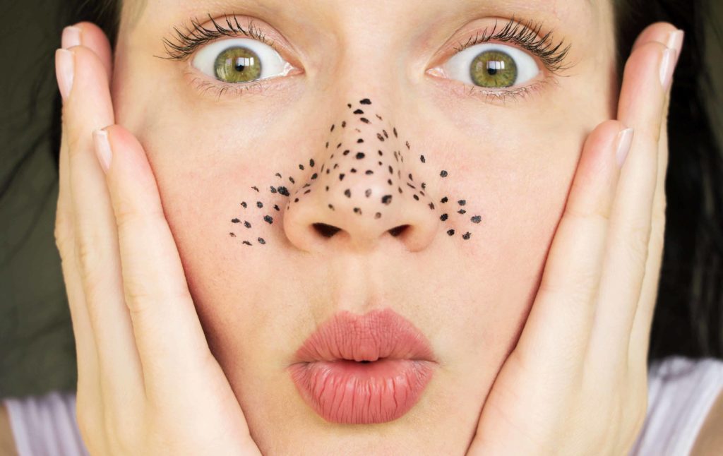 how to treat blackheads in the skin Bloom Clinic