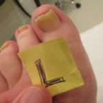 Infection free toe nails - with laser