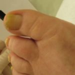 Infection free toe nails - with laser