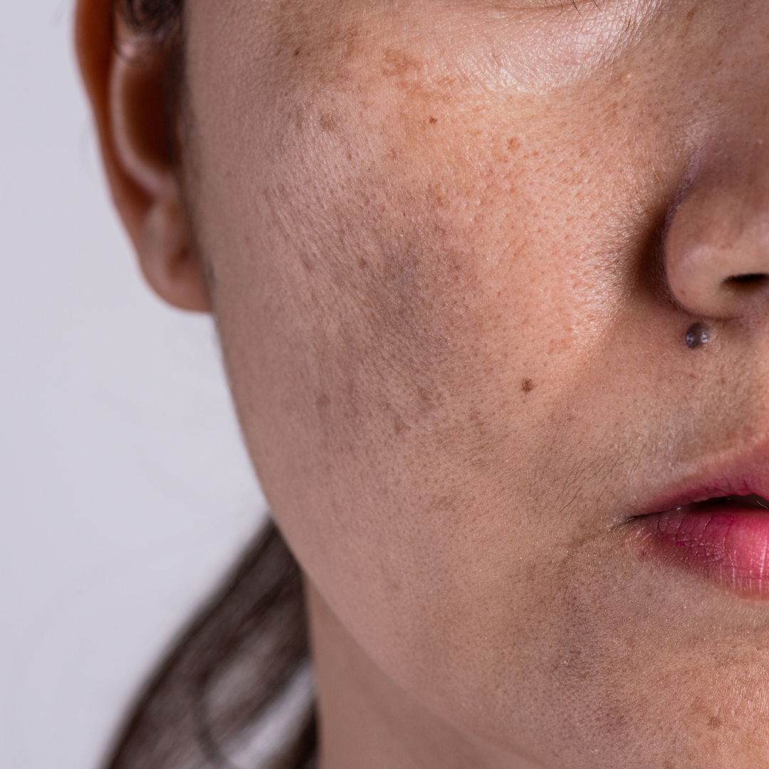 Melasma Treatment | Bloom Clinic