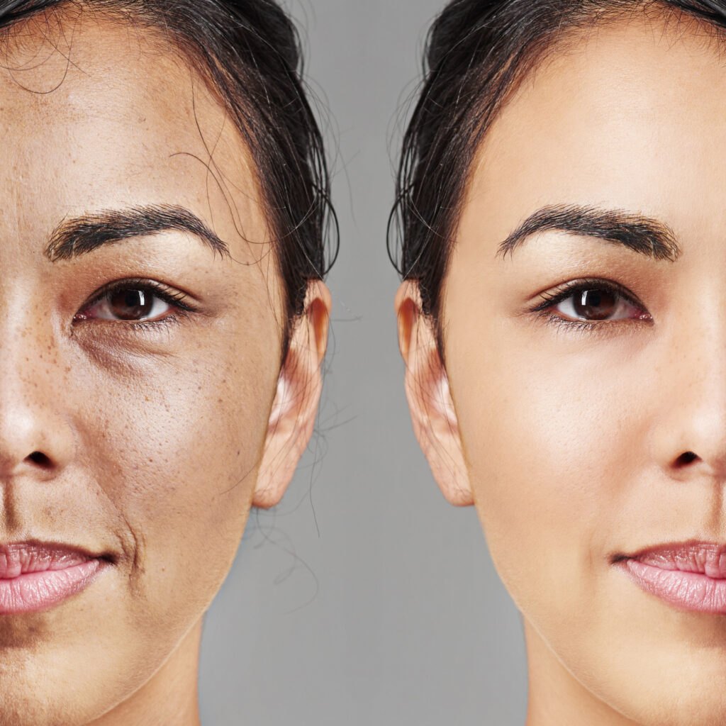 Dysport® Injectables Before and After
