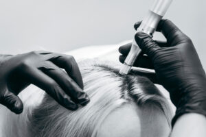 Young,Blonde,Woman,With,Hair,Loss,Problem,Receiving,Injection,,Close