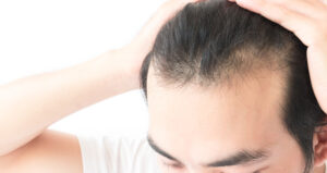 Young,Man,Serious,Hair,Loss,Problem,For,Health,Care,Shampoo