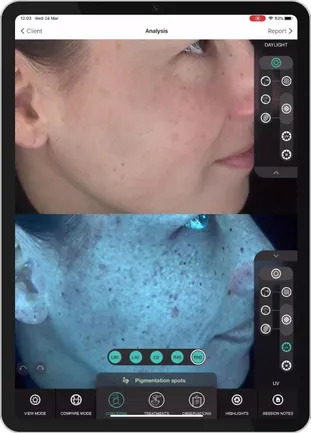 Melasma Treatment