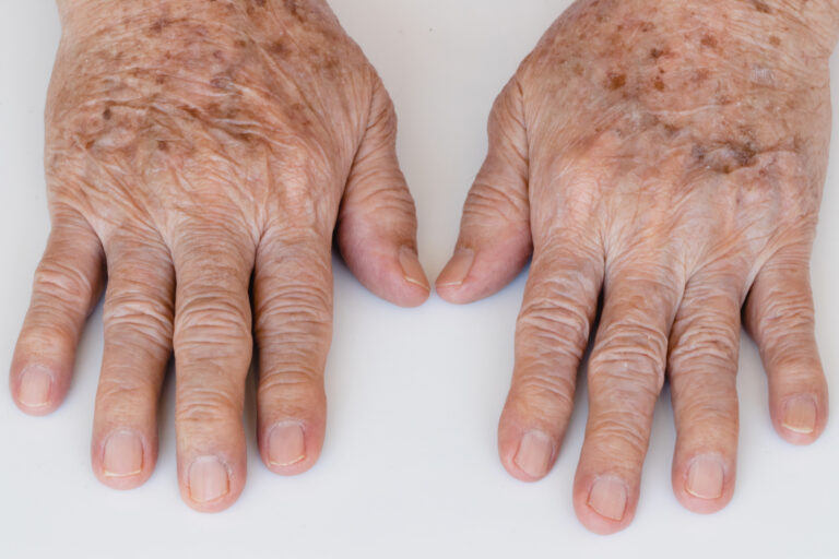 Pigmentation