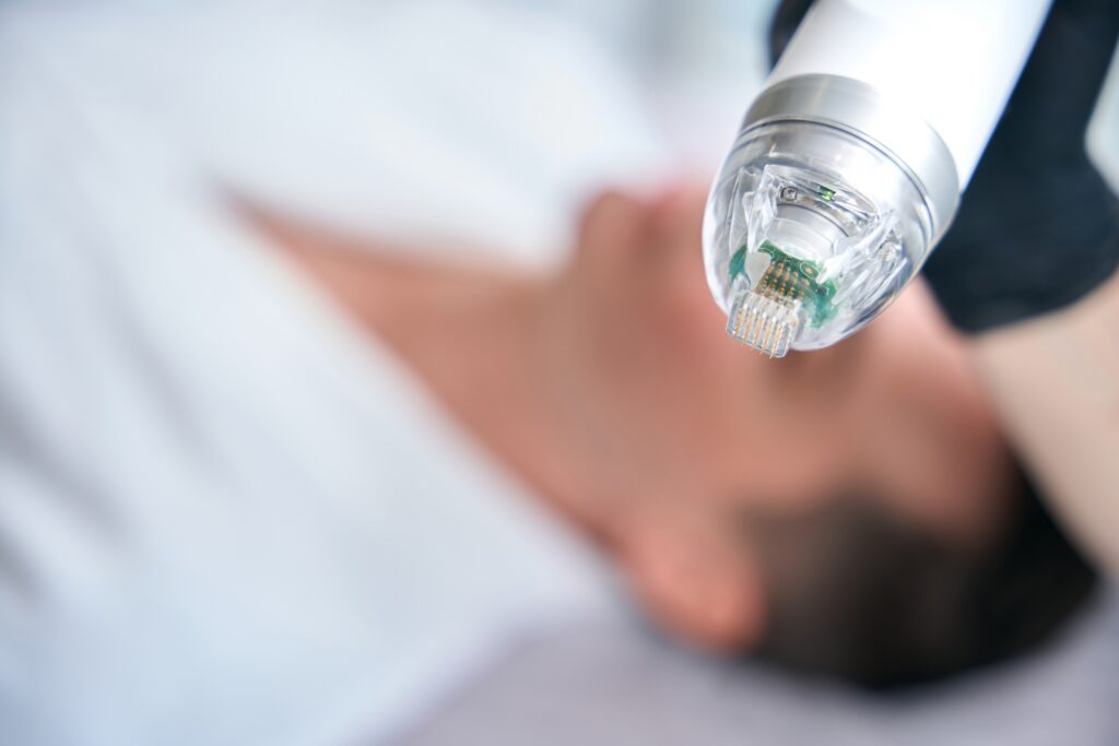 Dermal Needling