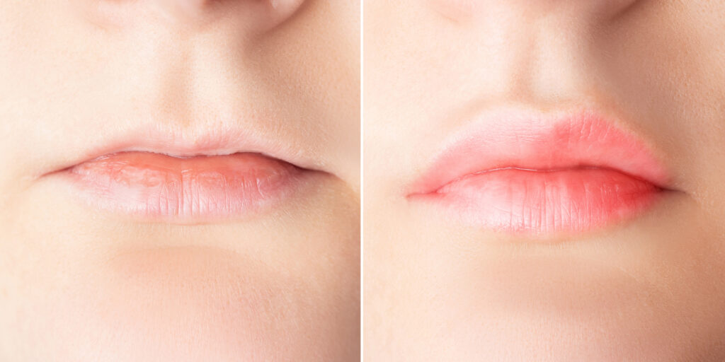 Lip Treatments